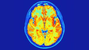 Researchers Discover a New Neurodevelopmental Disorder Embedded in Our Genes