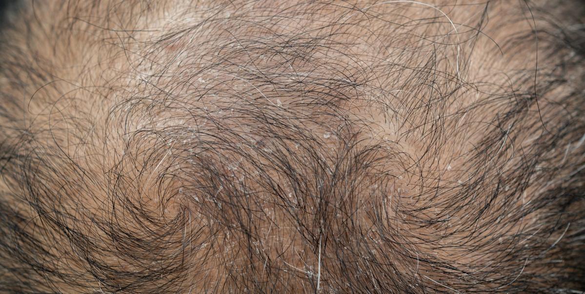 Researchers Discovered a Substance That May Aid in Hair Regrowth. It Could Be in Your Kitchen.