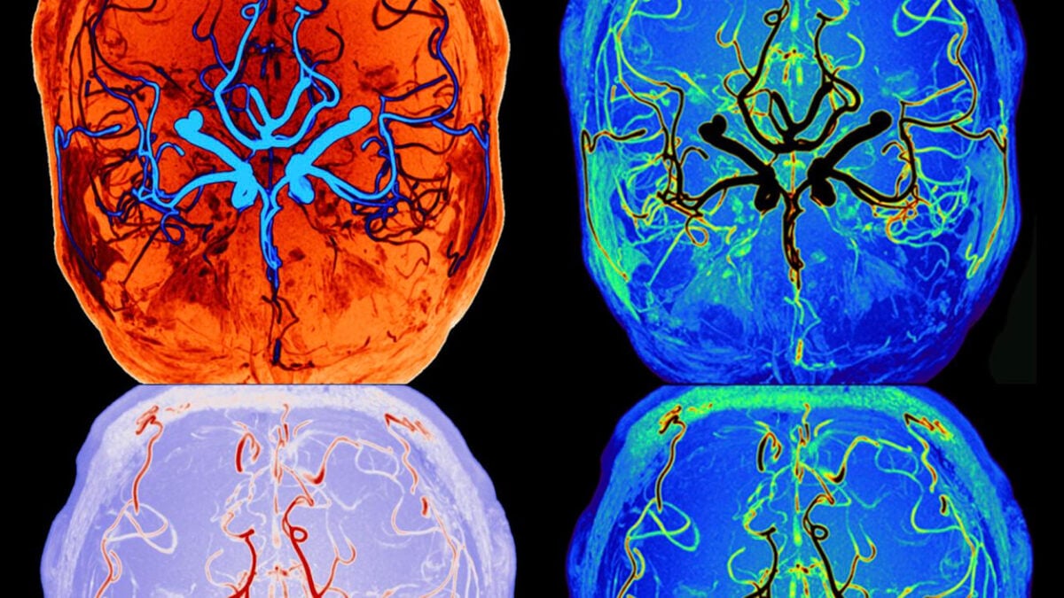 Researchers Observe the Brain's Cleanup Mechanism While Sleeping in Real Time