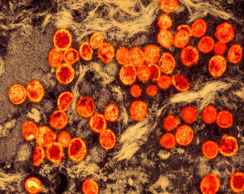 San Francisco Has Its First Clade I Mpox Case &mdash; What You Should Know and Where to Get a Vaccine