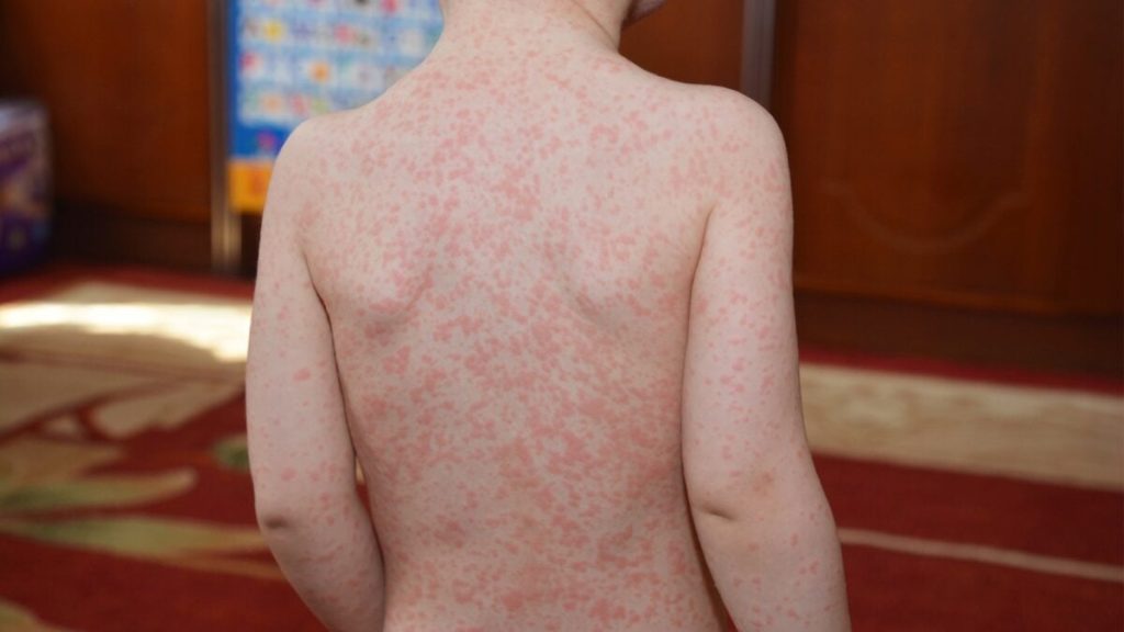 The Teenage Experience with Mono Might Have a Worrying Follow-up