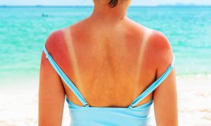 The main reason for sunburn has been found, and it's time to change the textbooks.