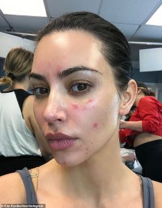 The surge in psoriasis cases and how to treat it without medication: With increasing numbers affected, many develop serious conditions and doctors often misdiagnose them. Now, experts share their insights.