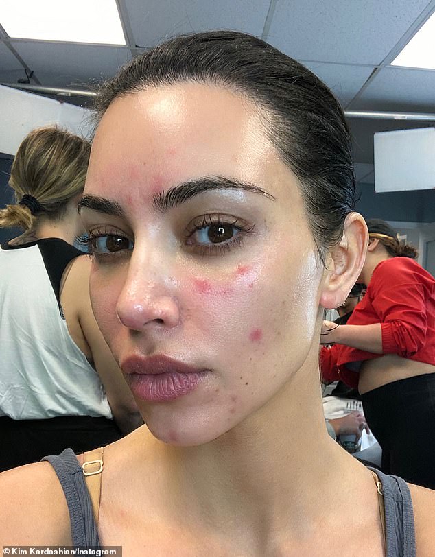 The surge in psoriasis cases and how to treat it without medication: With increasing numbers affected, many develop serious conditions and doctors often misdiagnose them. Now, experts share their insights.