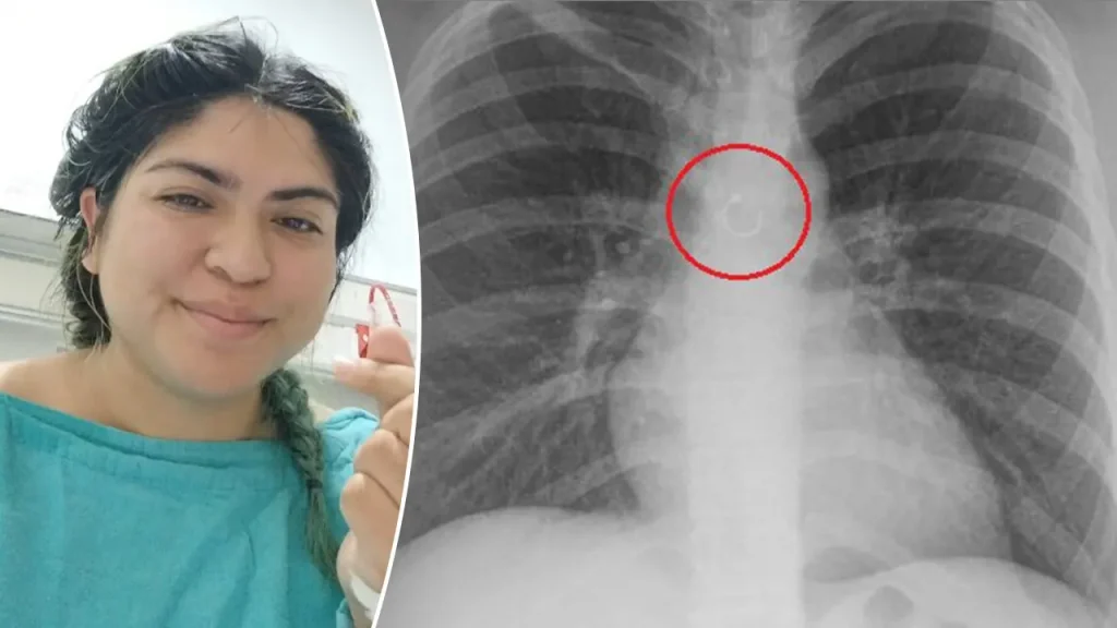 TikToker reveals that swallowed nose ring was only 0.5mm away from her aorta