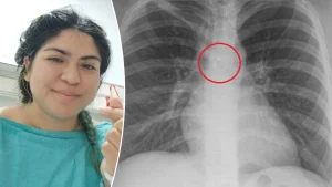 TikToker reveals that swallowed nose ring was only 0.5mm away from her aorta