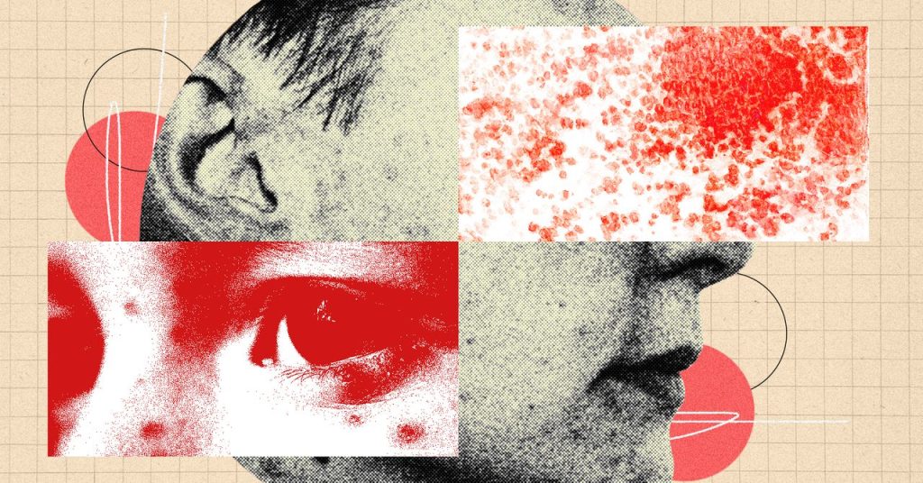 You Should Be More Concerned About Shingles