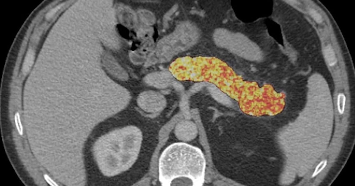 AI detects indicators of pancreatic cancer prior to tumor formation