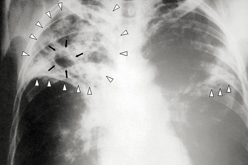 Ancient disease reaches a 12-year peak in California amid new outbreak information
