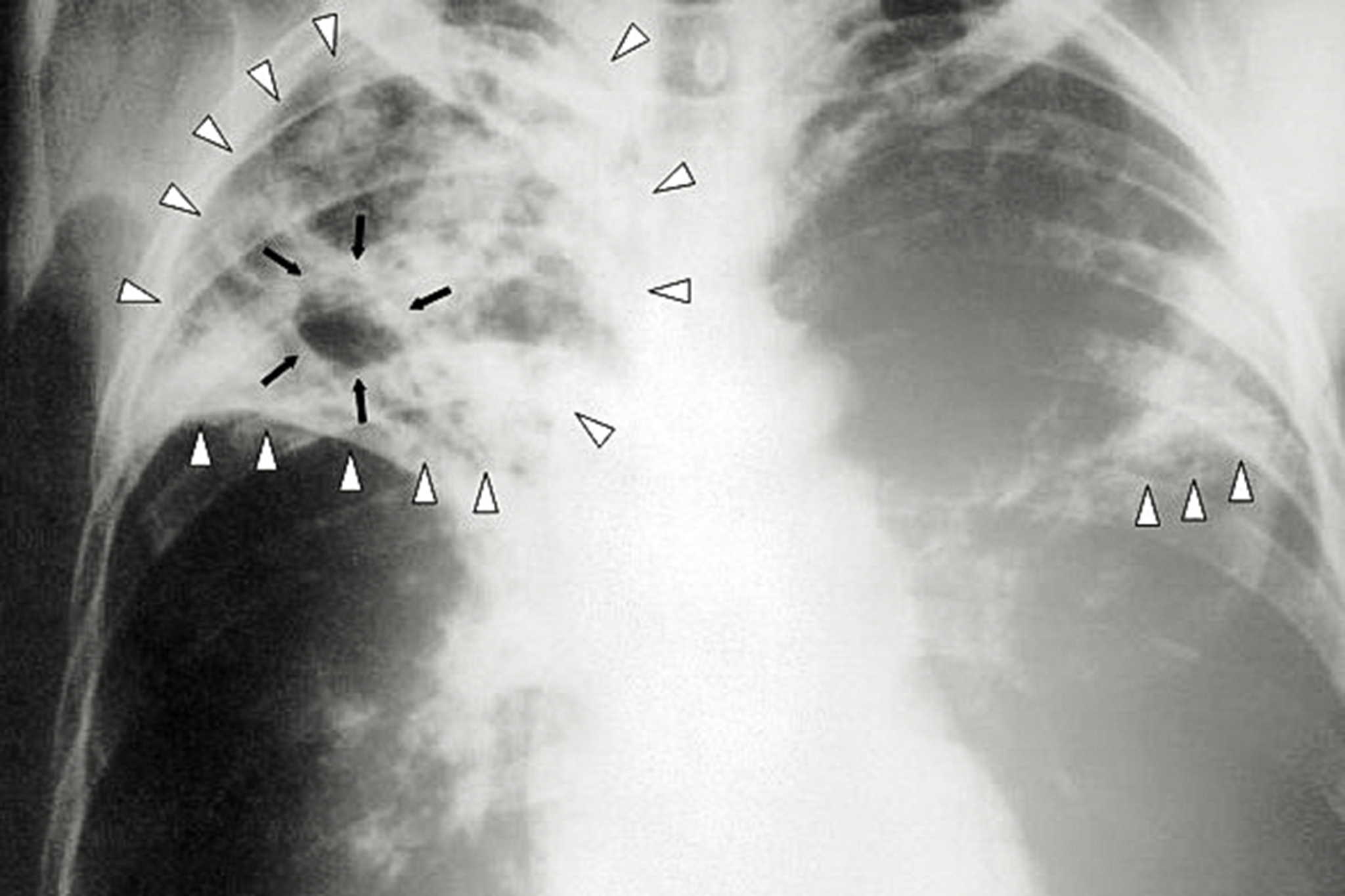 Ancient disease reaches a 12-year peak in California amid new outbreak information