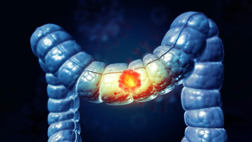 Colon cancer advancement helps patients remain cancer-free for almost 3 years