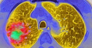 GLP-1 medications might lower the chances of cancer advancing, research indicates