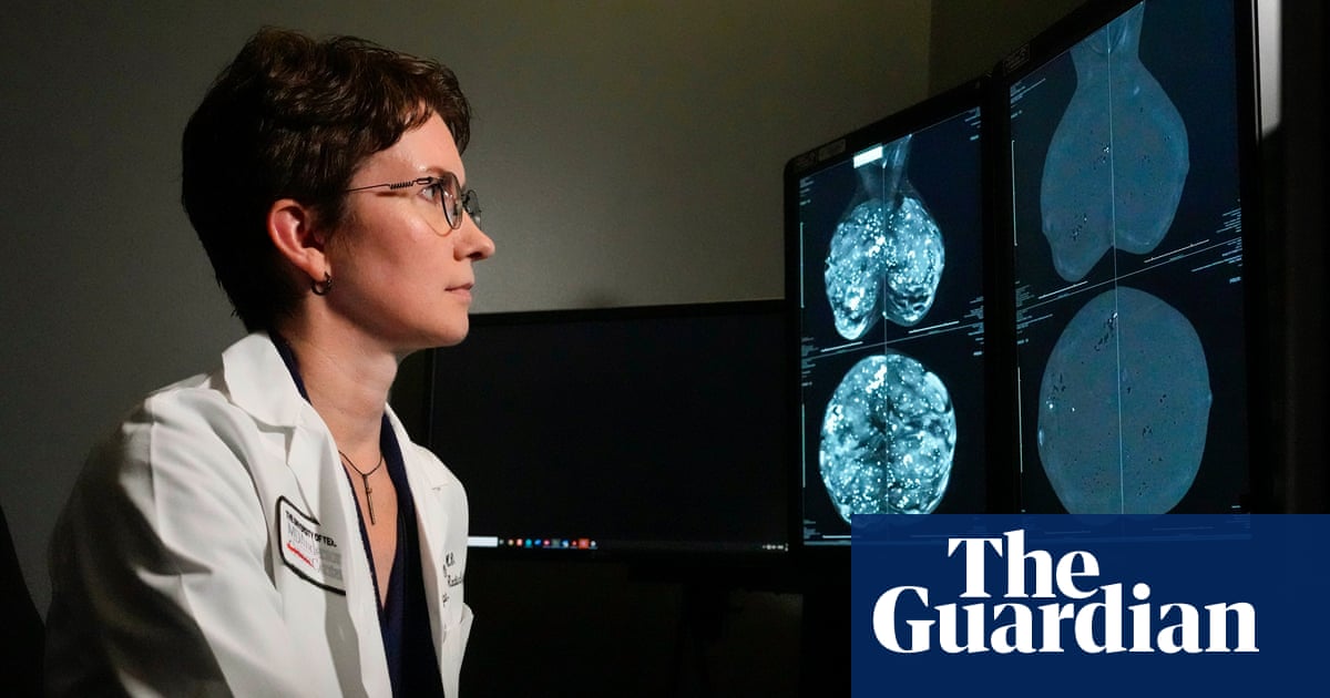 Innovative genetic test may save millions of breast cancer patients from chemotherapy