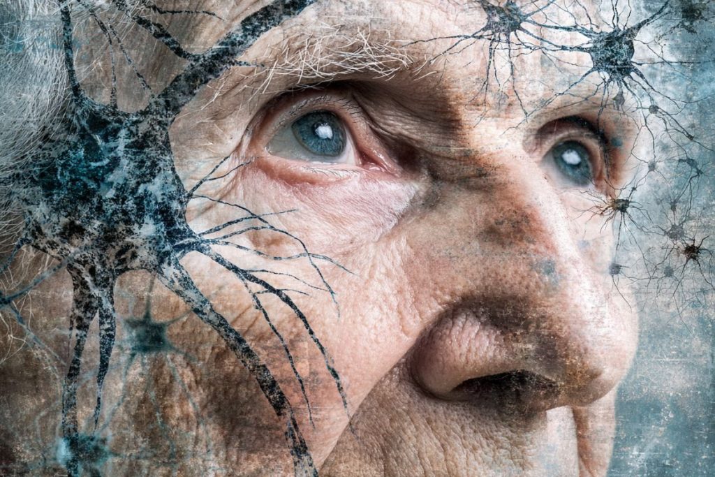Medication for Parkinson's Reclaims Memories in Alzheimer's
