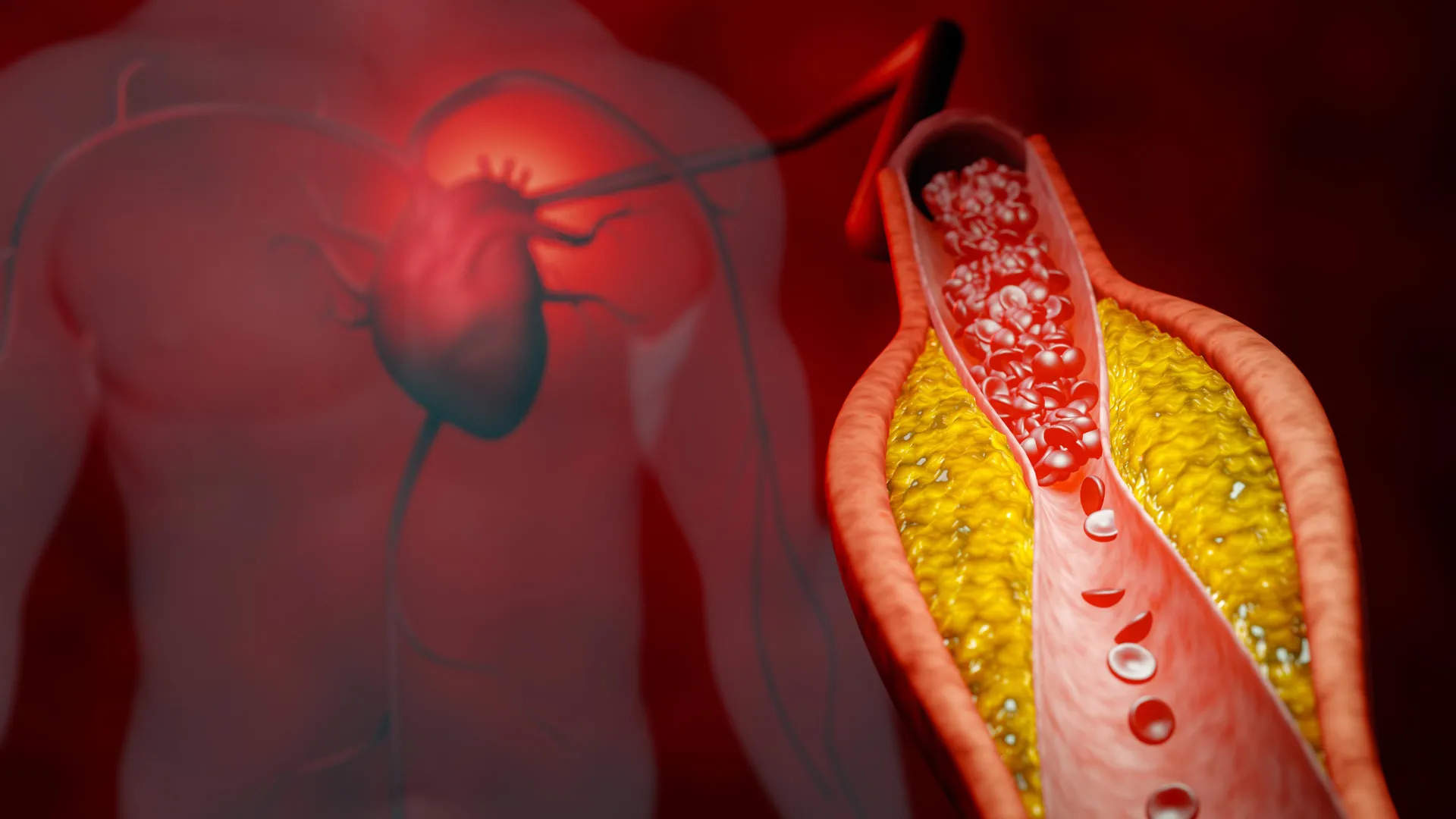 New approach reduces harmful cholesterol by almost 50% without statins
