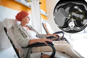 New tool detects most lethal cancer years before tumors are visible on scans.