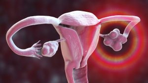 PCOS Has Been Renamed After Years of Misunderstanding