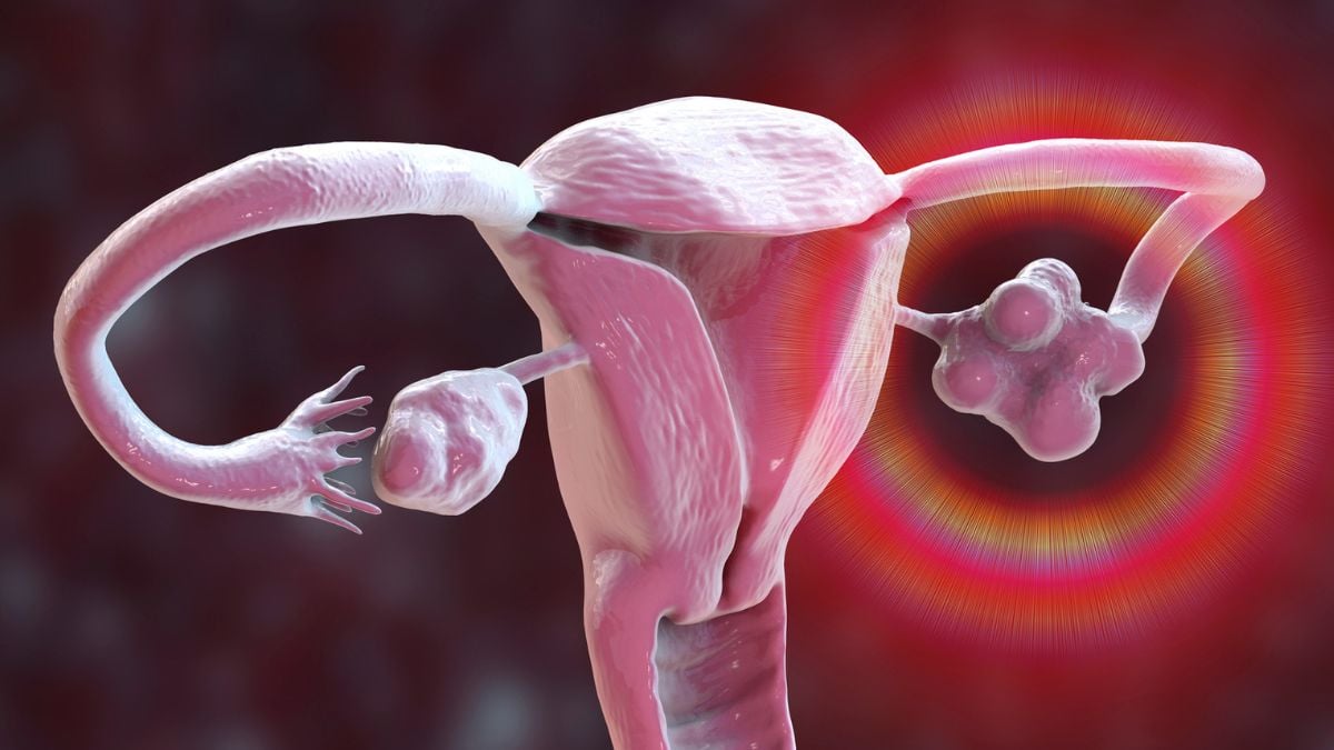 PCOS Has Been Renamed After Years of Misunderstanding