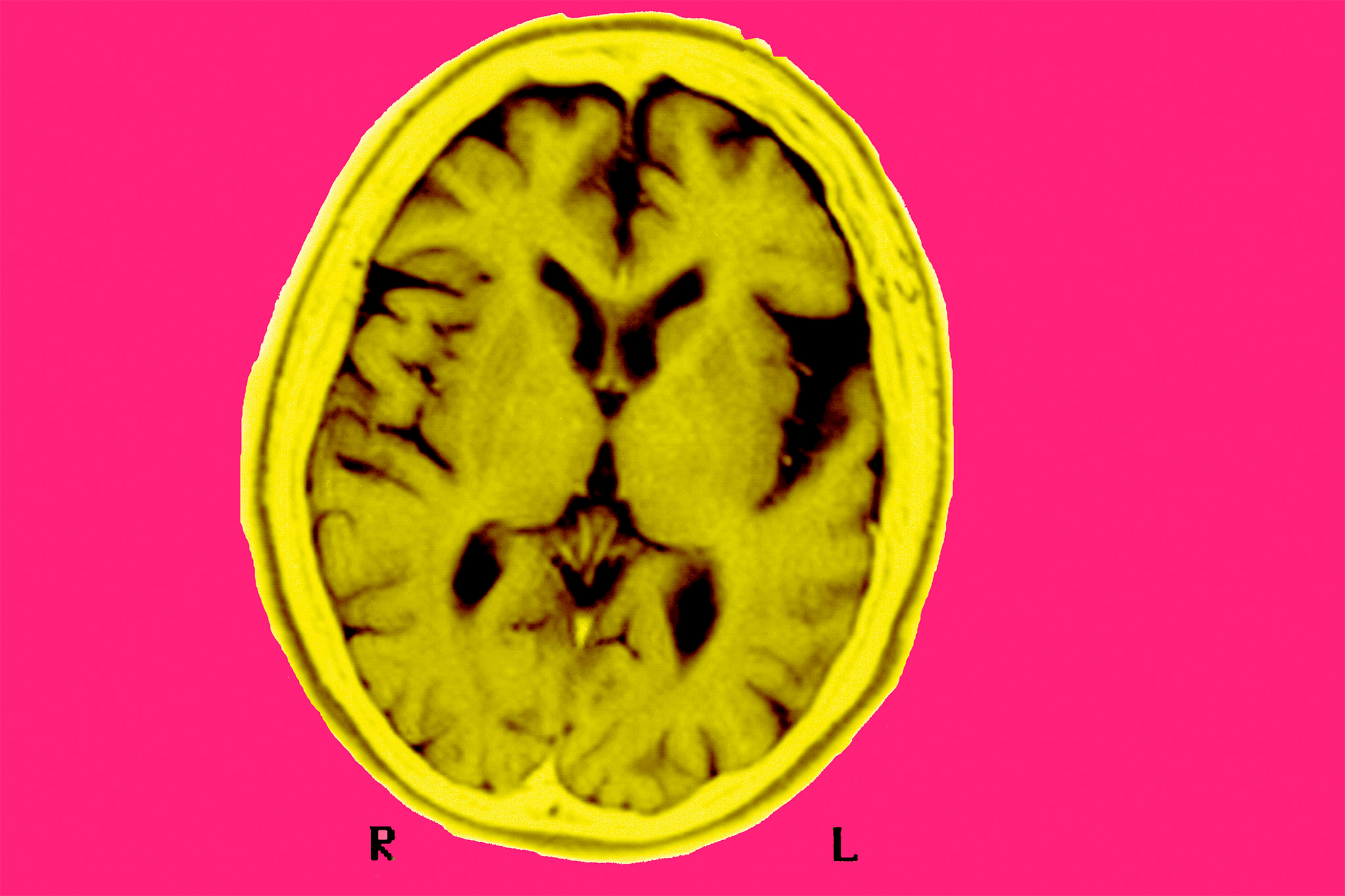 Research indicates blood test could detect early signs of cognitive issues.