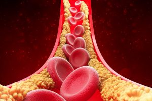 Researchers have discovered a new kind of cholesterol, which may be the most harmful.