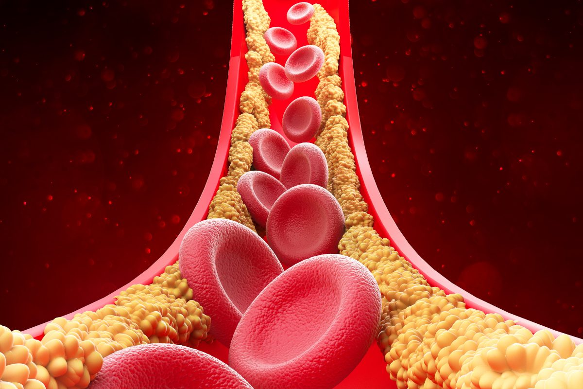 Researchers have discovered a new kind of cholesterol, which may be the most harmful.