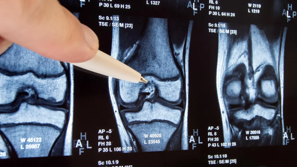 Typical knee surgery shown to be unhelpful and possibly harmful.