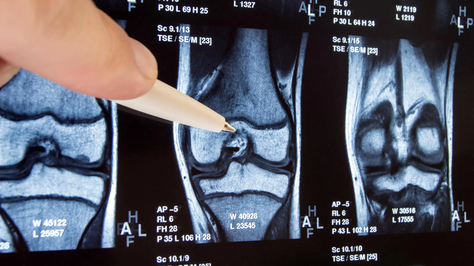 Typical knee surgery shown to be unhelpful and possibly harmful.