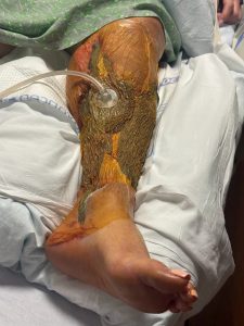 Vibrio season is increasing as 5 people from Florida are affected by a severe infection