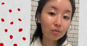 What is a nose job associated with Accutane?