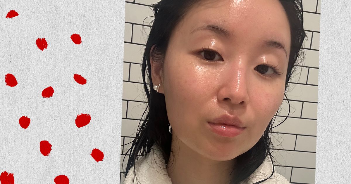 What is a nose job associated with Accutane?
