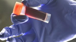 Your Blood Type Influences the Chances of Early Stroke, Study Finds