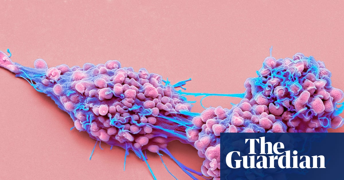 Approval granted for life-extending medication for advanced ovarian cancer in England