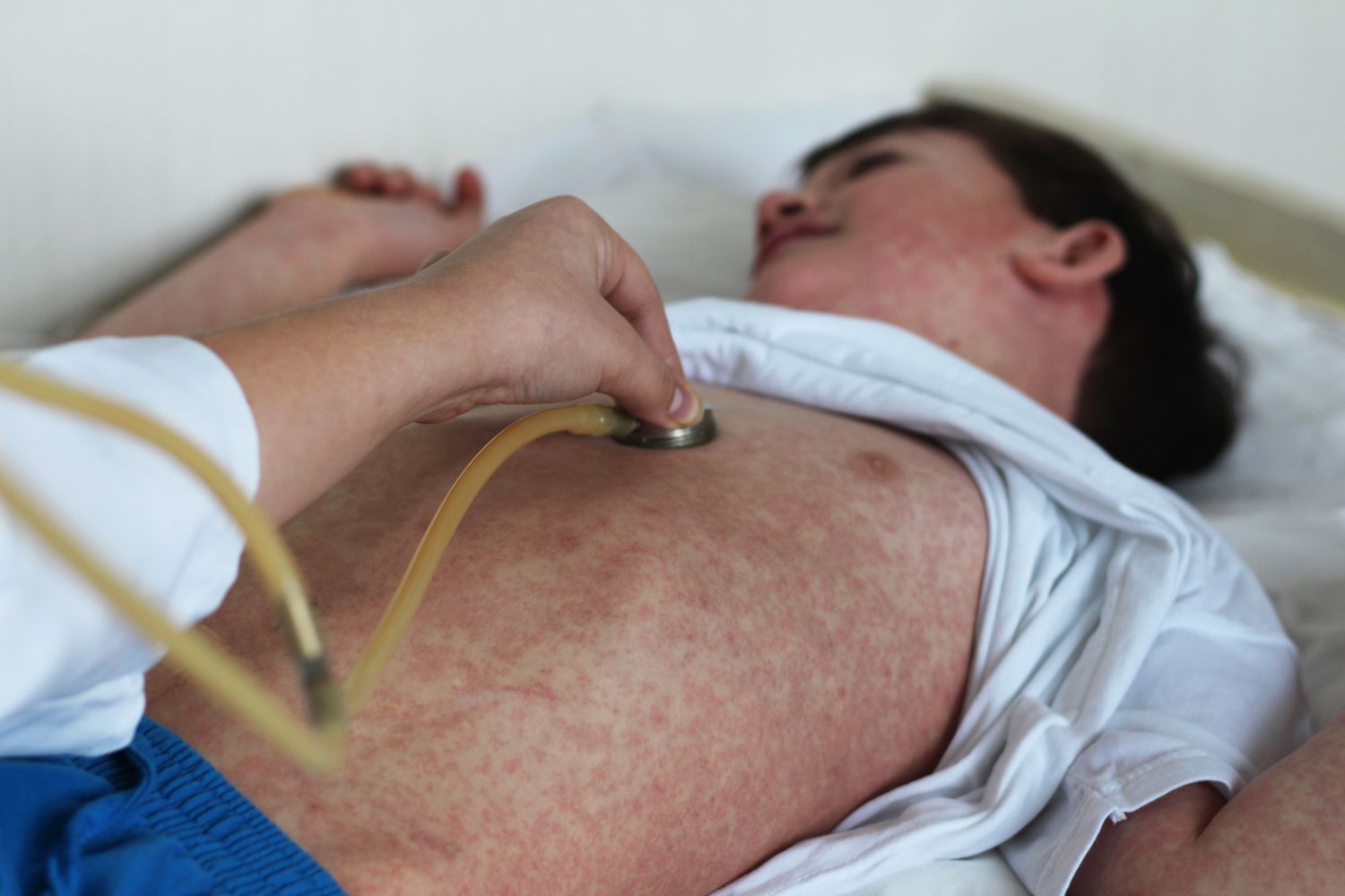 Experts discuss the current measles outbreak and what the future holds.