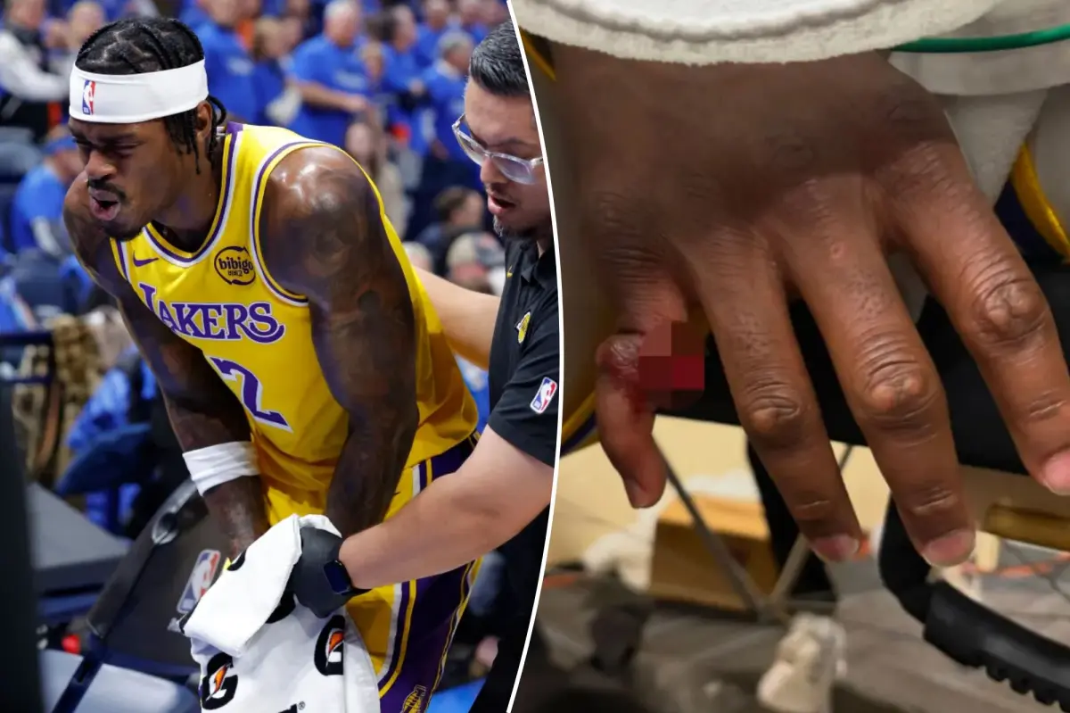 Jarred Vanderbilt of the Lakers reveals shocking images of a severe finger injury