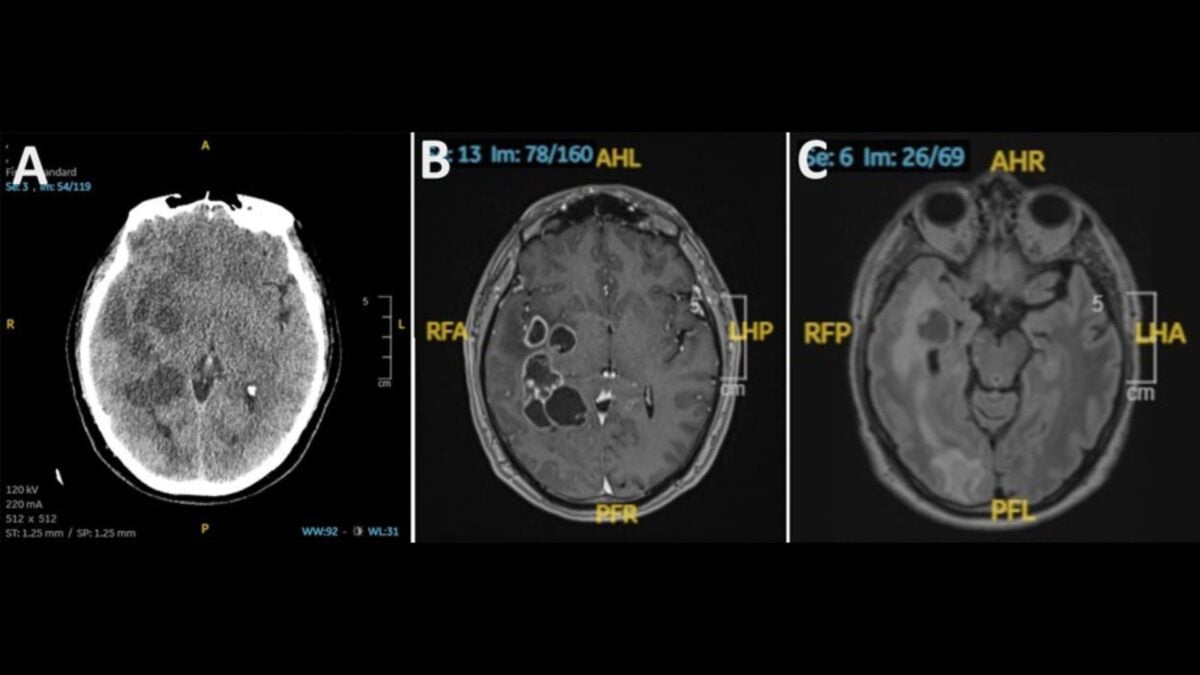 Man's Suspected Brain Tumor Proves to Be Something Much More Chilling