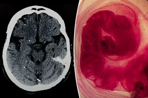 Man's 'fatal brain cancer' is actually something more unpleasant.
