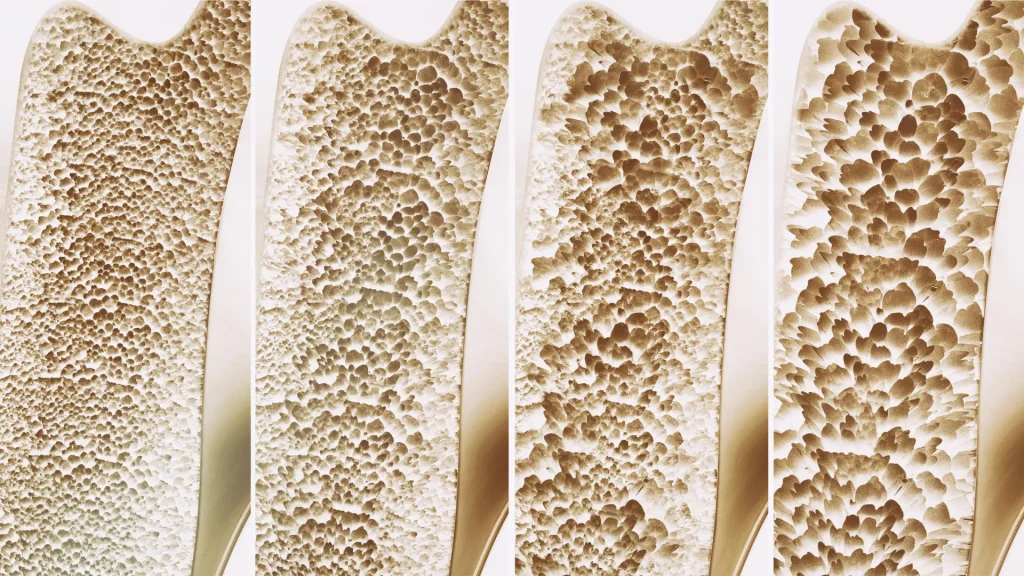 Many people use calcium and vitamin D for stronger bones, but a significant review shows minimal advantage.
