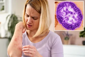 Measles detected in California wastewater as health officials raise concerns