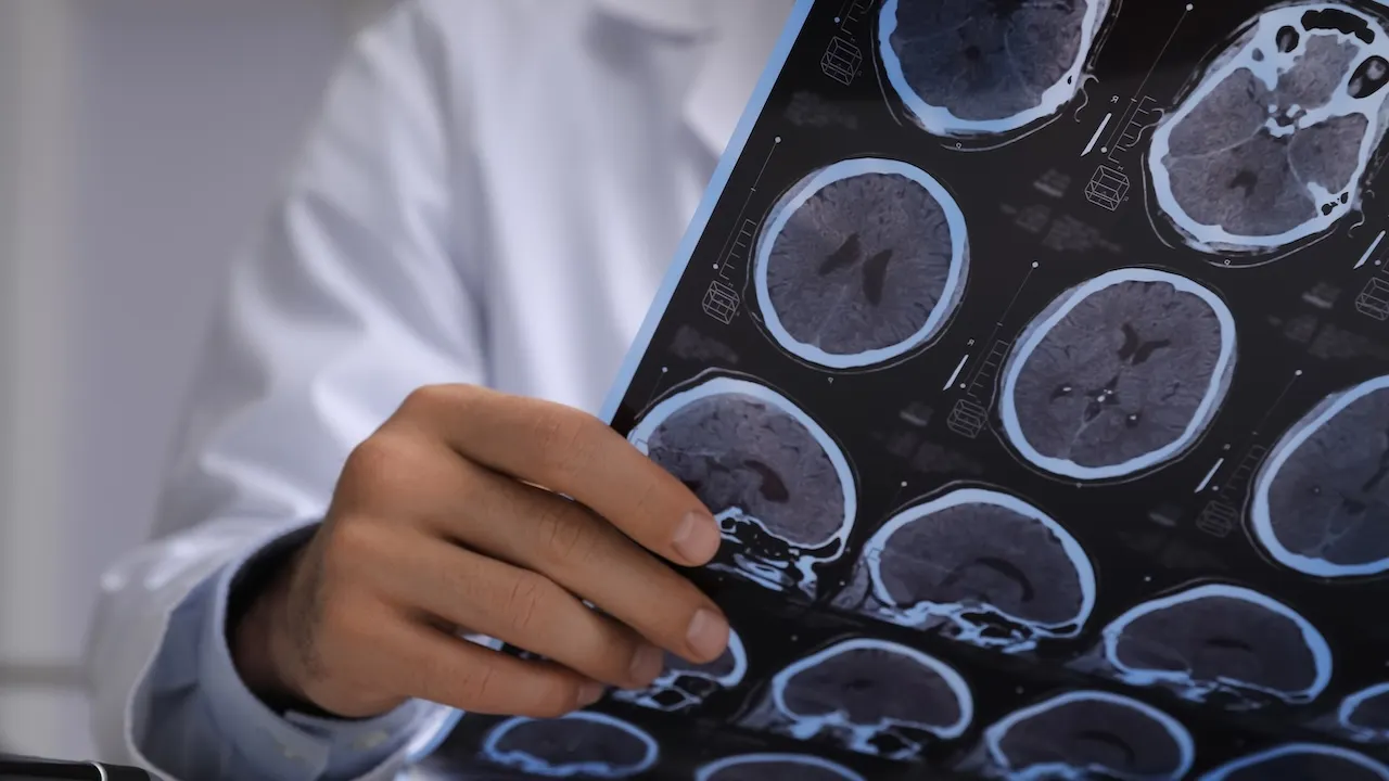 Misdiagnosis of brain cancer is actually a pork tapeworm infection