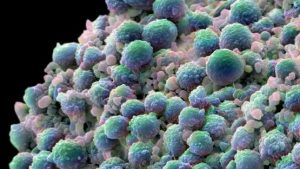 New treatment eliminates prostate tumor cells and stimulates antitumor immunity
