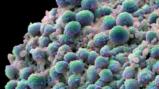 New treatment eliminates prostate tumor cells and stimulates antitumor immunity