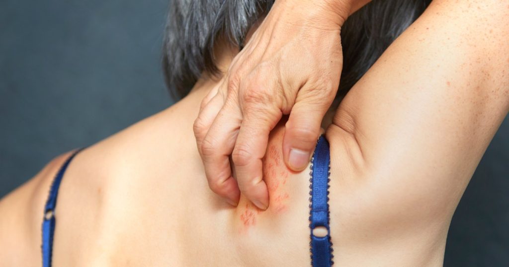 Shingles is associated with brain inflammation. Studies reveal ways to reduce dementia risk.