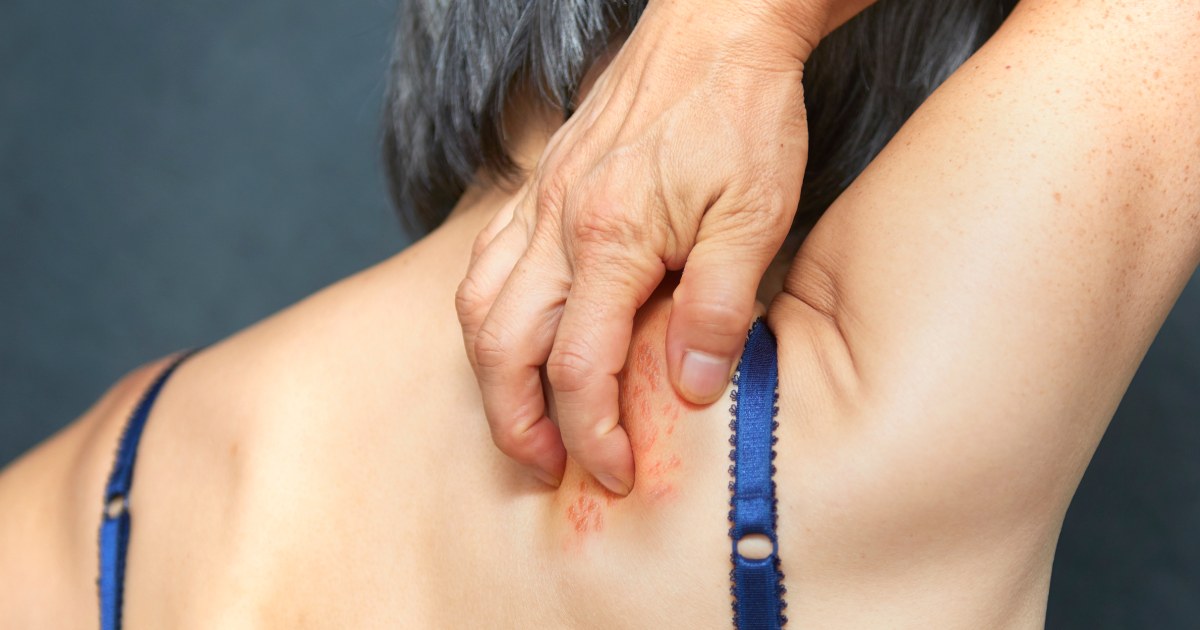 Shingles is associated with brain inflammation. Studies reveal ways to reduce dementia risk.