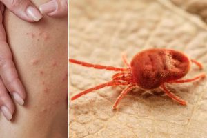 The reality of how chiggers bite skin is unsettling