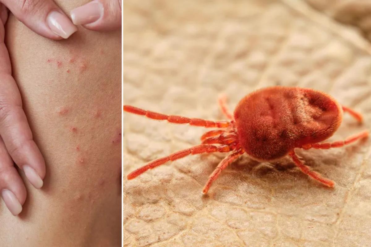 The reality of how chiggers bite skin is unsettling