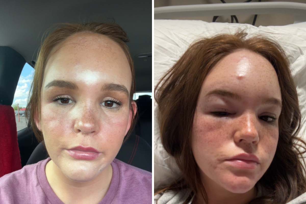 Doctors Thought It Was a Spider Bite, Then She Began to Lose Her Sight