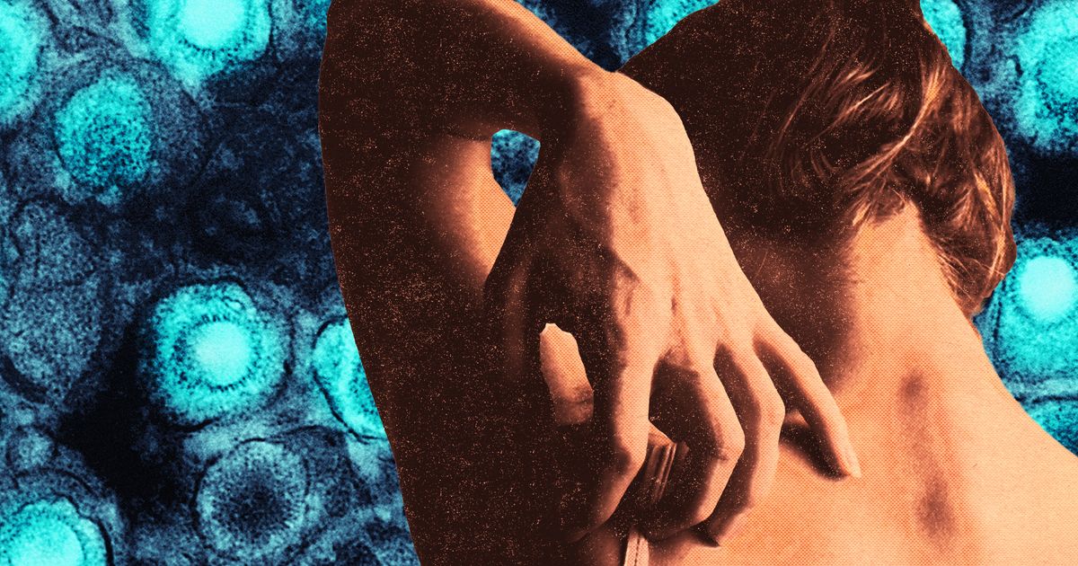 Millennial Women Need to Be Cautious About Shingles