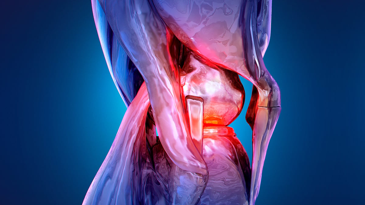 New Procedure Reduces Knee Pain by 50% in Year-Long Study