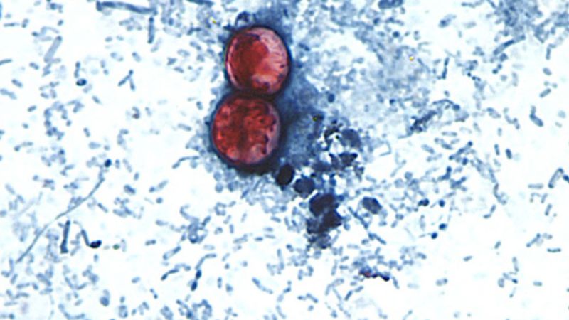 Parasite that causes diarrhea can contaminate raw foods, leading to suffering in multiple states