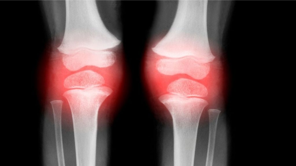 Single Injection Successfully Reverses Osteoarthritis in Animals Within 4 Weeks